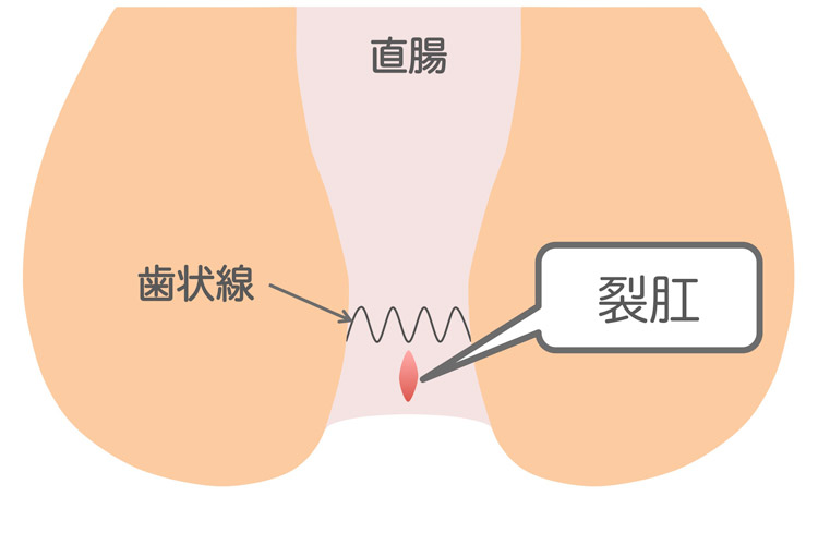 痔核(いぼ痔)とはのイメージ画像