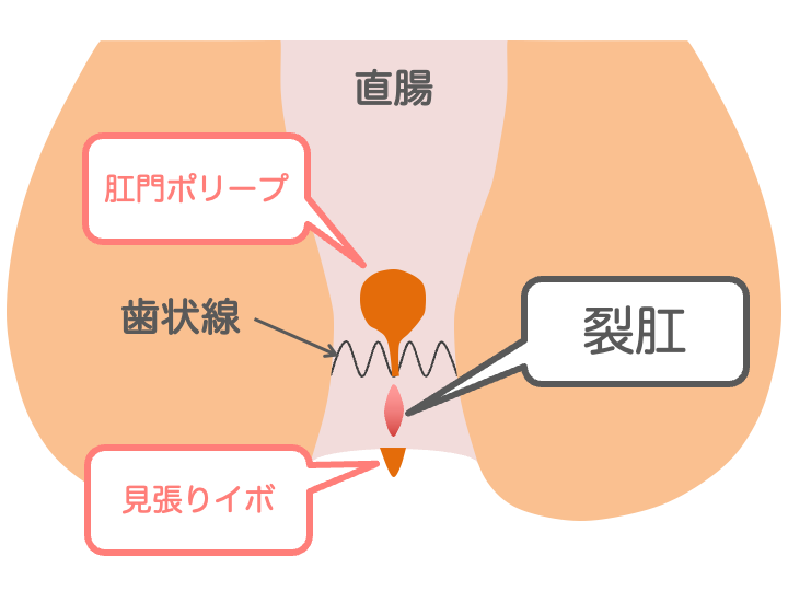 裂肛(切れ痔)の症状のイメージ画像