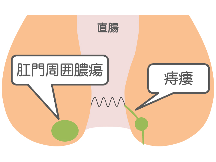 痔瘻・肛門周囲膿瘍