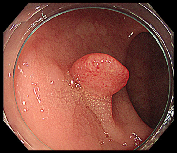 大腸ポリープ(腺腫)の内視鏡検査写真のイメージ画像