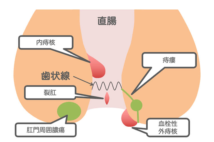痔