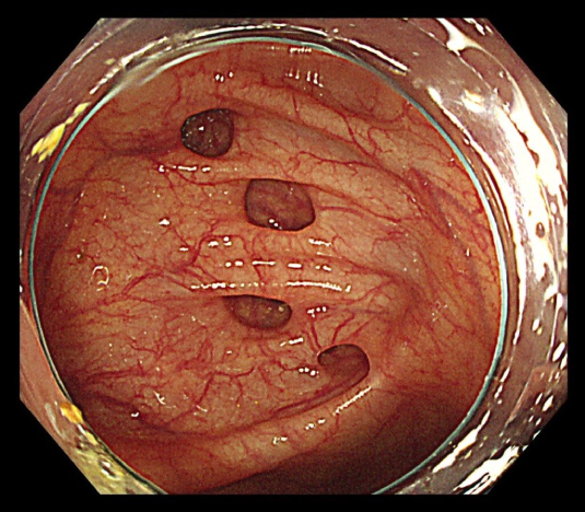 大腸憩室症の大腸内視鏡検査写真