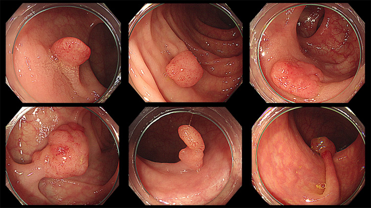 大腸ポリープイメージ画像