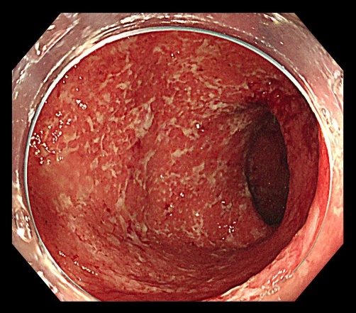 炎症性腸疾患(IBD)のイメージ画像