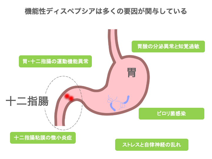 機能性ディスペプシアの原因