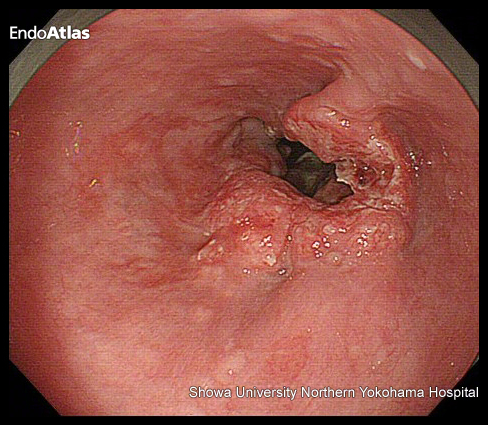 【進行食道がんの内視鏡検査画像】（OLYMPUS EndoAtlasより引用）