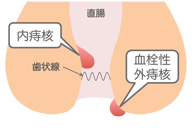 痔核（いぼ痔）とはのイメージ画像