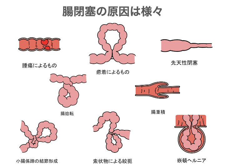腸閉塞（イレウス）