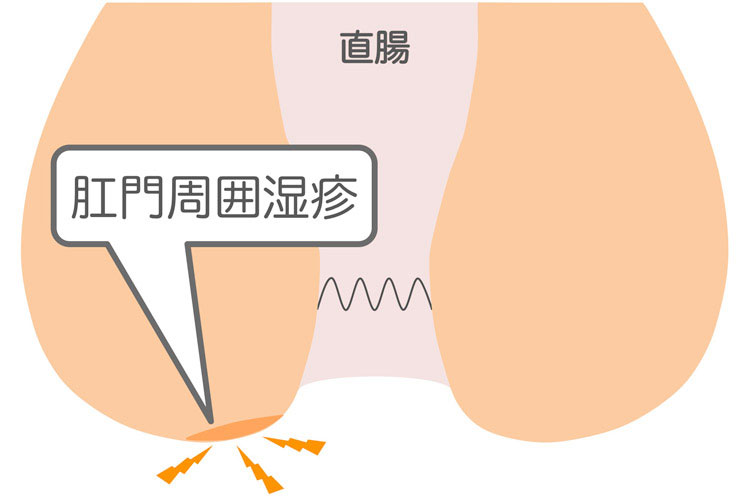 肛門周囲湿疹とは