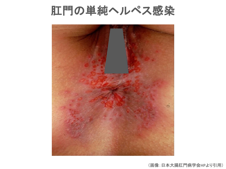 肛門ヘルペス感染症の症状