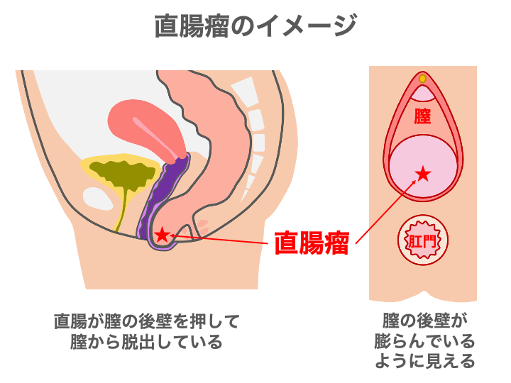 直腸瘤とは