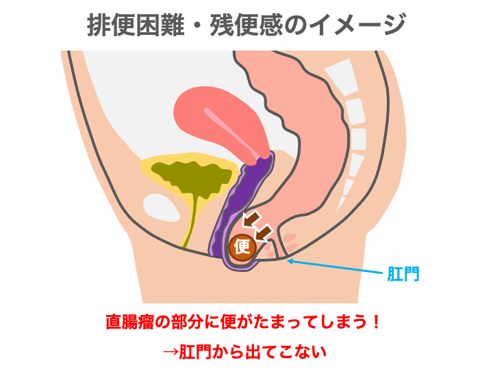 直腸瘤の症状