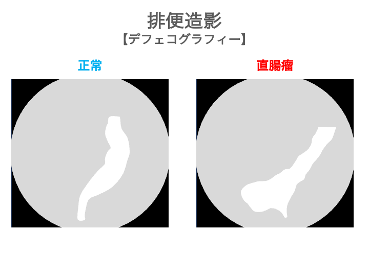 直腸瘤の検査・診断